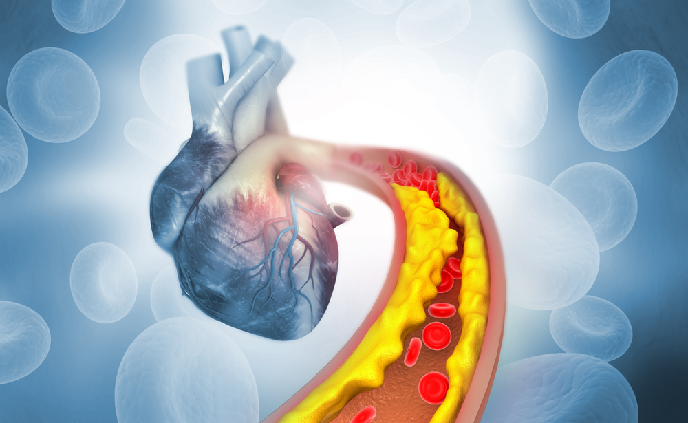 Yüksek Kolesterol Kalp Damar Sağlığını Nasıl Etkiler?